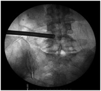 Endoscopic Spine Surgery