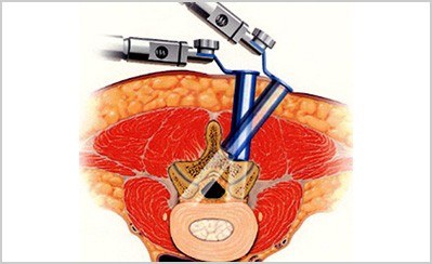 Minimally Invasive Keyhole Laminectomy