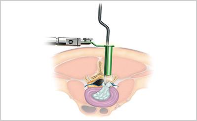 minimally-invasive-microdiscectomy