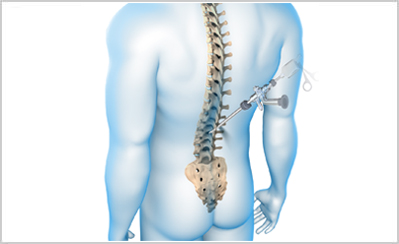 Endoscopic Spine Surgery